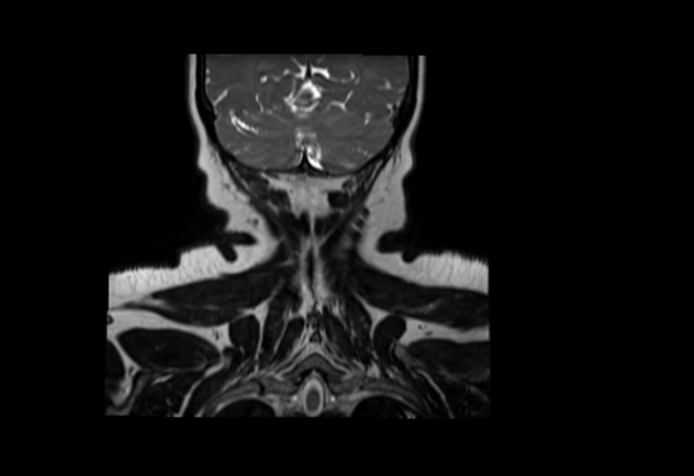 Neck coronal lymph node cross sectional MRI anatomy 3T MRI  image-img-00001-00008.webp